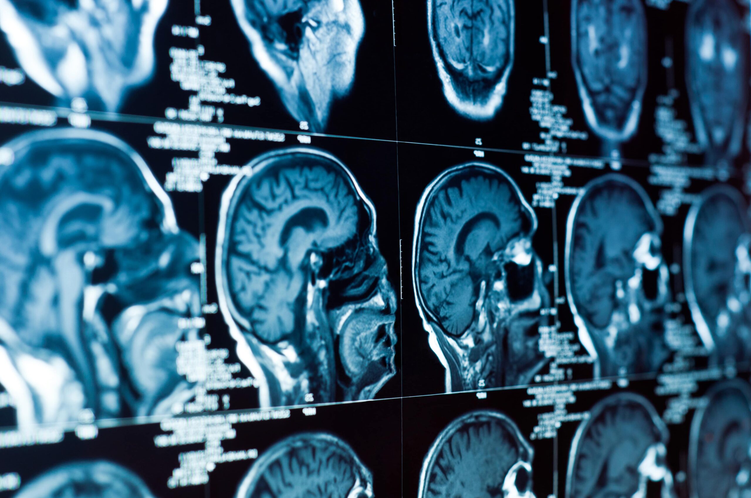 Broward County brain injury lawyer reviewing a legal case file