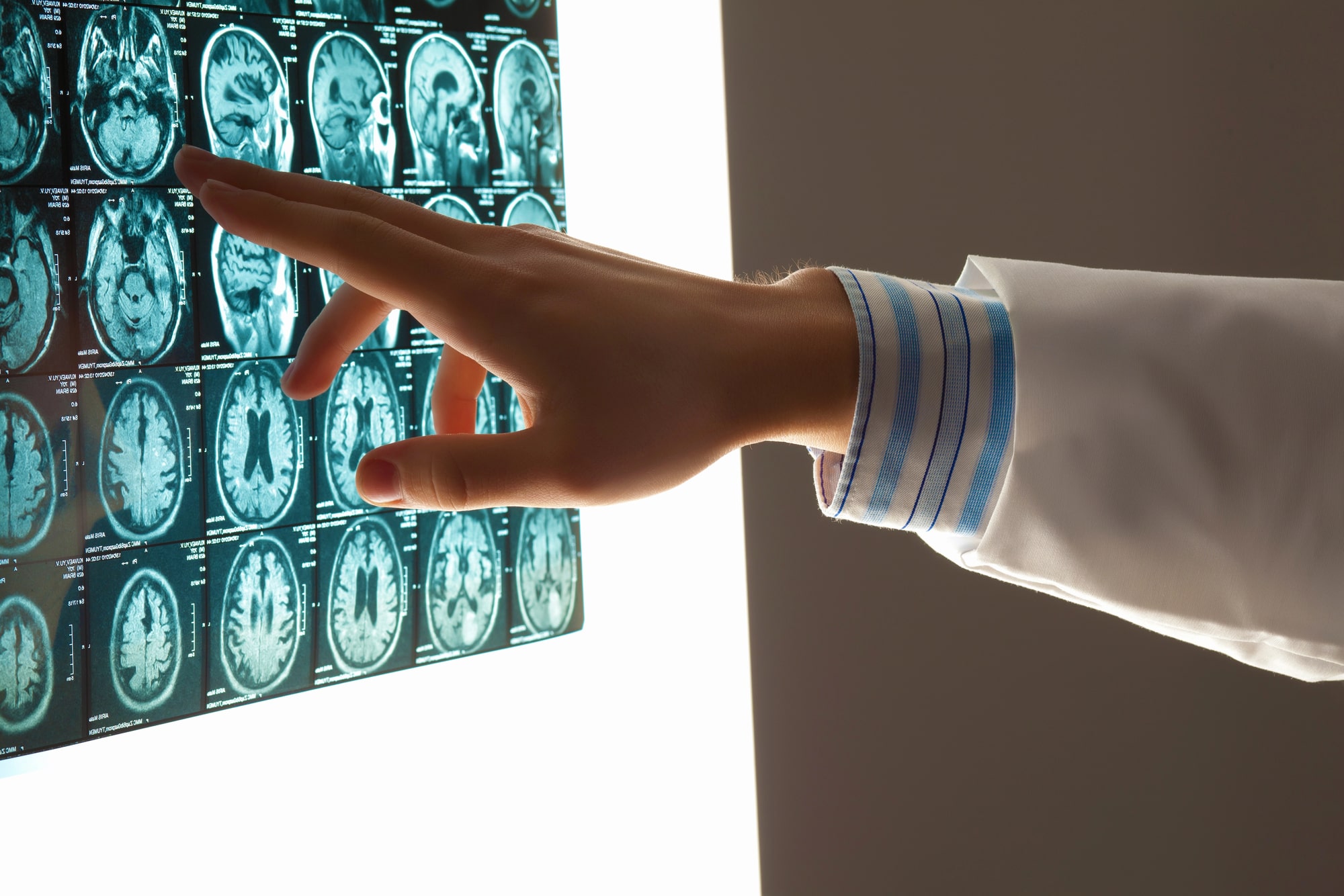 TBI Lawyer Parkland, FL