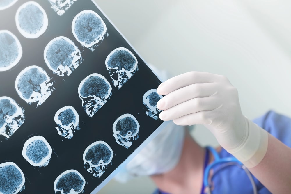 TBI Lawyer Tamarac, FL